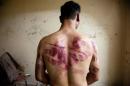 A Syrian man shows marks of torture on his back, after he was released from regime forces, in the Bustan Pasha neighbourhood of Syria's northern city of Aleppo on August 23, 2012
