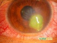隱形眼鏡族細菌感染　角膜潰瘍險失明