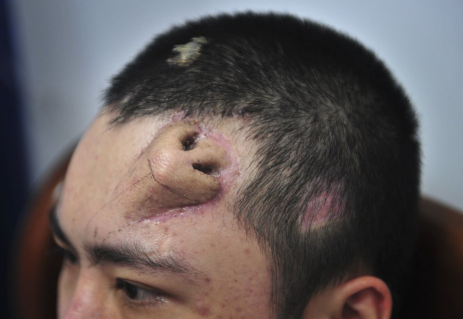 In this Tuesday Sept. 24, 2013 photo, a 22-year-old patient, with a surgical made extra nose out of his rib cartilage and implanted under the skin of his forehead, rests at Fujian Medical University Union Hospital, in Fuzhou city, in southeast China's Fujian province. A surgeon in China said he has constructed the extra nose to prepare for a transplant in probably the first operation of its kind. Surgeon Guo Zhihui at the hospital spent nine months cultivating the graft for the man whose nose was damaged. (AP Photo) CHINA OUT