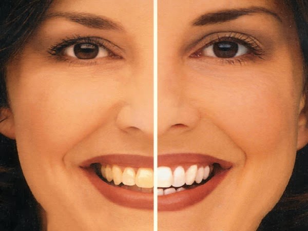 Πώς να λευκάνεις μόνη σου τα δόντια σου με φυσικό τρόπο.. Είναι πανεύκολο!