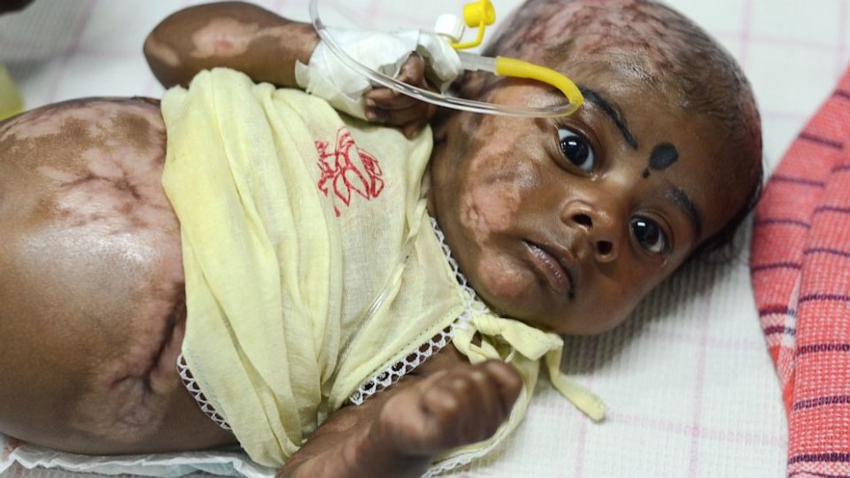 Doctors Investigate Indian Baby for Spontaneous Combustion