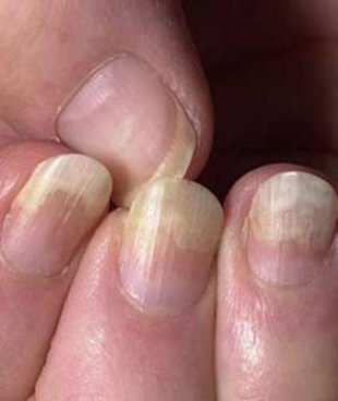 Brittle, thin, or lifted nails