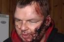 In this frame grab provided by 5 Channel, bloody Dmytro Bulatov speaks to press after he was found near Kiev, Ukraine, Jan. 31, 2014. Bulatov, an opposition protester who disappeared more than a week ago says he was kidnapped and tortured by unknown assailants, in a chilling development that is likely to further stoke anger against the embattled government of President Viktor Yanukovych. Dmytro Bulatov, is the latest in a string of disappearances and mysterious attacks on prominent opposition leaders, which left one activist dead and several badly beaten. (AP Photo/5 Channel)