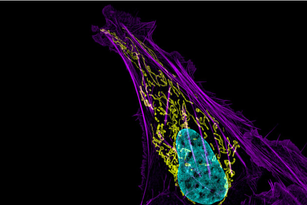 أفضل الصور المجهرية في مسابقة عالمية 03-human-bone-cancer-jpg_162007
