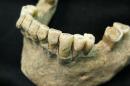 'Microbial Pompeii' Found on Teeth of 1,000-Year-Old Skeletons
