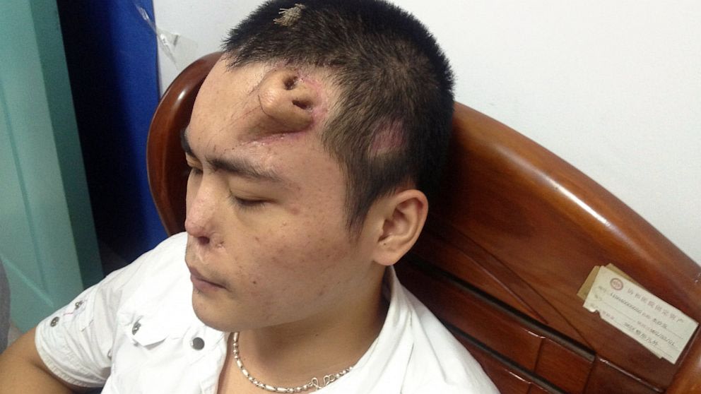 Doctors Grow Nose on Man's Forehead