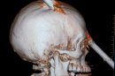 This tomography scan released Thursday, Aug. 16, 2012 by the Miguel Couto hospital, shows the skull of 24-year-old construction worker Eduardo Leite pierced by a metal bar in Rio de Janeiro, Brazil. Doctors say Leite survived after a 6-foot metal bar fell from above him and pierced his head. Luiz Essinger of Rio de Janeiro's Miguel Couto Hospital Friday told the Globo TV network that doctor's successfully withdrew the iron bar during a five-hour-long surgery. (AP Photo/Miguel Couto Hospital)