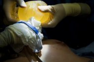 Cirurgião retira implante mamário rompido da companhia PIP, em operação feita em Caracas, Venezuela, em janeiro de 2012